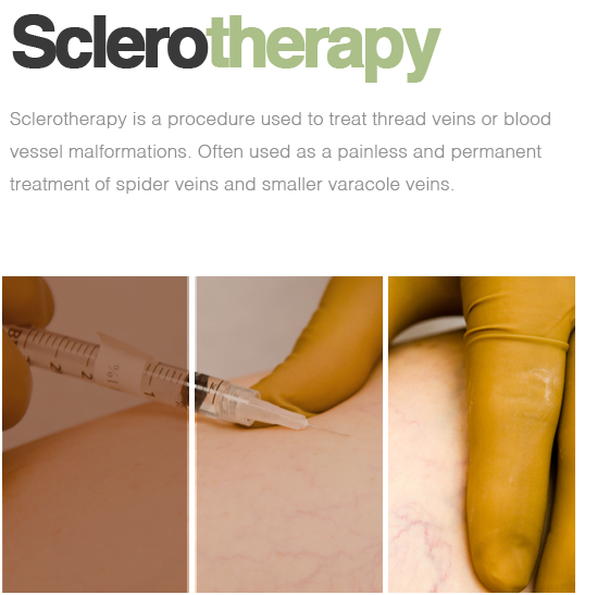 Sclerotherapy in marbella.